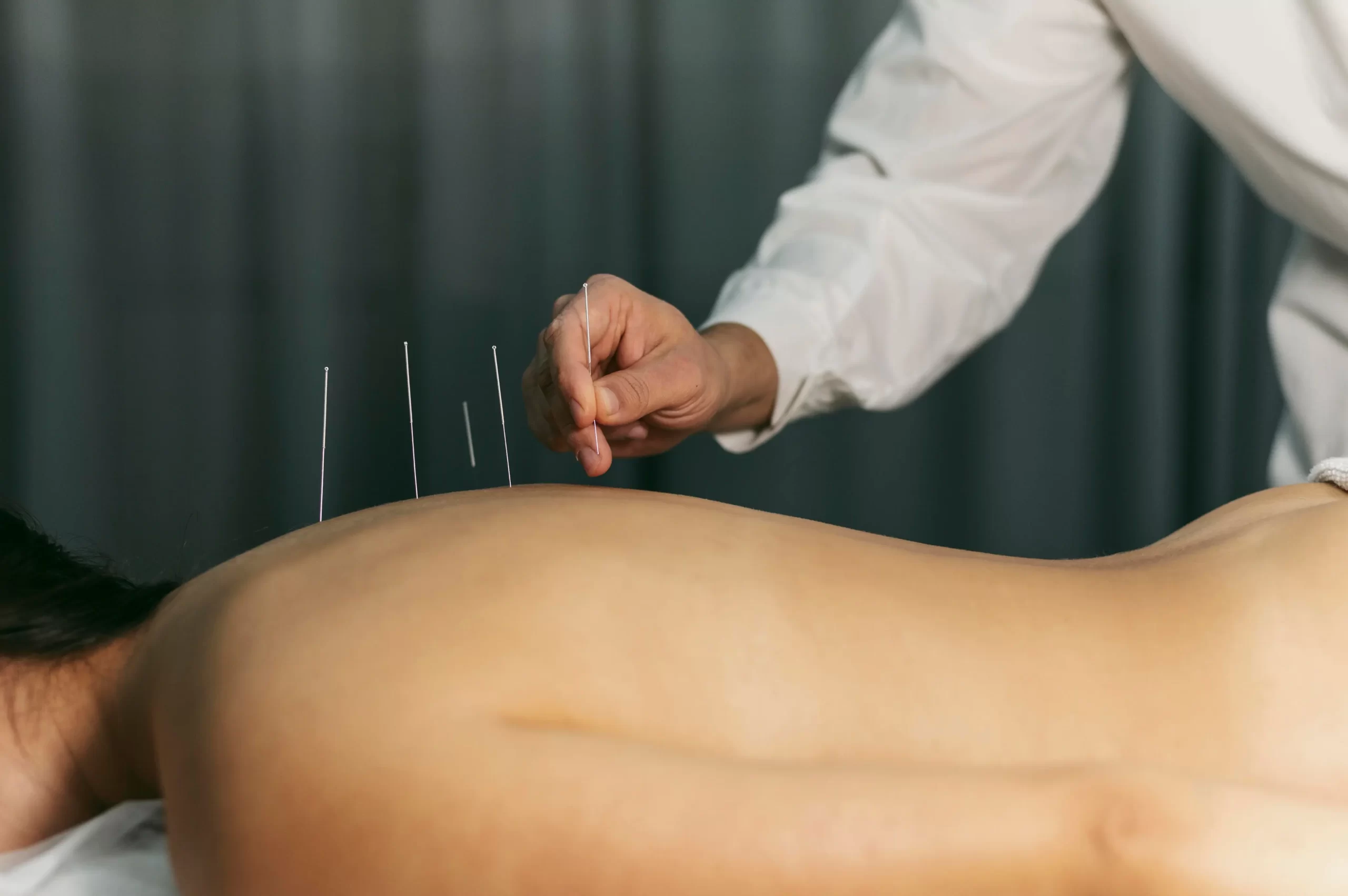Imagem do tratamento de Acupuntura Médica